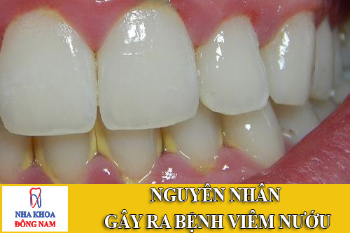 nguyên nhân gây ra bệnh viêm nướu