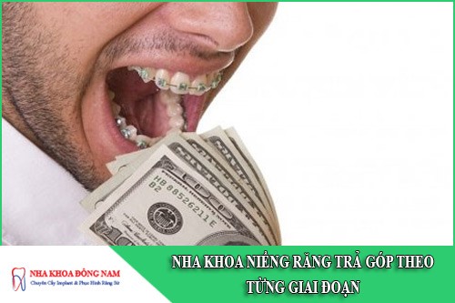 nha khoa niềng răng trả góp theo từng giai đoạn