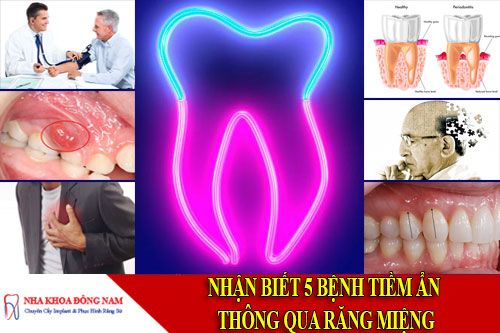 nhận biết 5 bệnh tiềm ẩn thông qua răng miệng