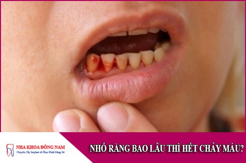 nhổ răng bao lâu thì hết chảy máu