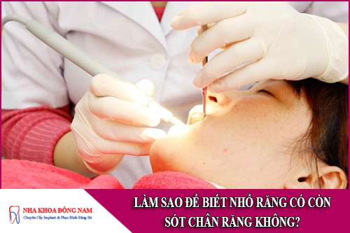 làm sao để biết nhổ răng có còn sót chân răng không