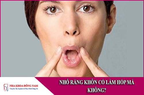 nhổ răng khôn có làm hóp má không