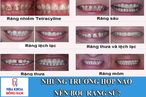những trường hợp nào nên bọc răng sứ