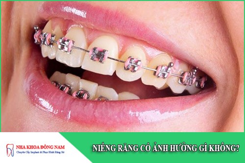 niềng răng có ảnh hưởng gì không