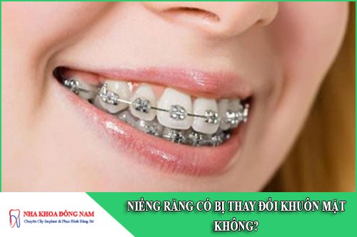 niềng răng có bị thay đổi khuôn mặt không