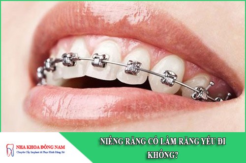 niềng răng có làm răng yếu đi không