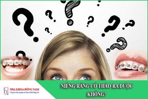 niềng răng có tháo ra được không