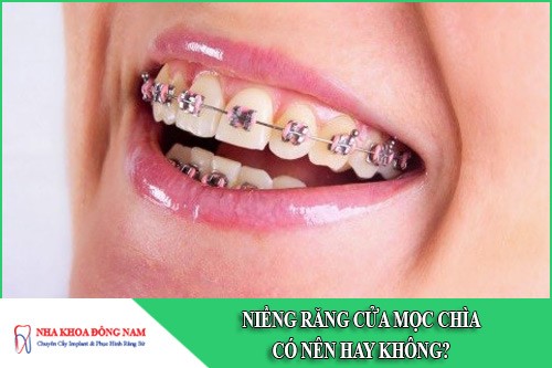 niềng răng cửa mọc chìa có nên hay không