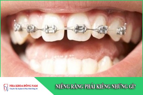 niềng răng phải kiêng những gì