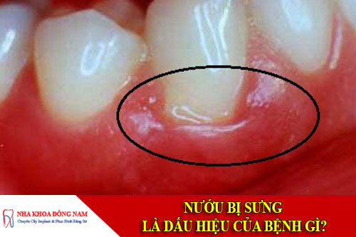 nướu bị sưng là dấu hiệu của bệnh gì