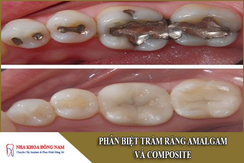phân biệt trám răng amalgam và composite