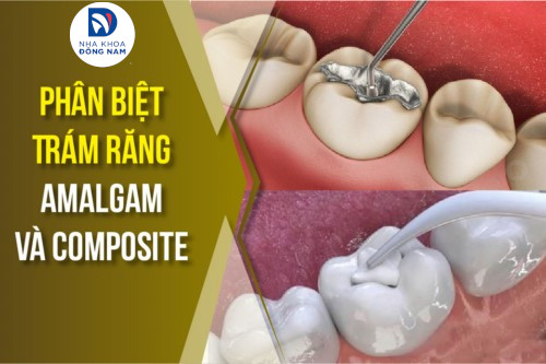 phân biệt trám răng amalgam và composite