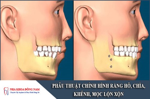 phẫu thuật chỉnh hình răng hô, chìa, khểnh, lộn xộn
