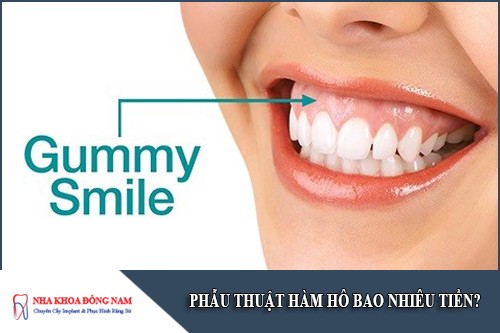 phẫu thuật hàm hô bao nhiêu tiền