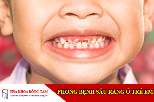phong benh sau rang o tre em