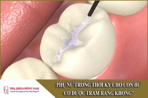 phụ nữ trong thời kỳ cho con bú có được trám răng không