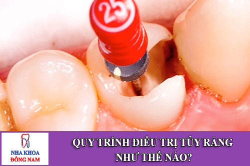 Quy trình điều trị tủy răng như thế nào