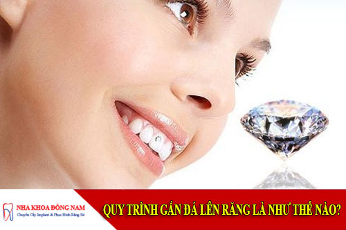 quy trình gắn đá lên răng như thế nào