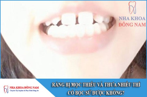răng bị mọc thiếu và thưa nhiều thì có bọc sứ được không