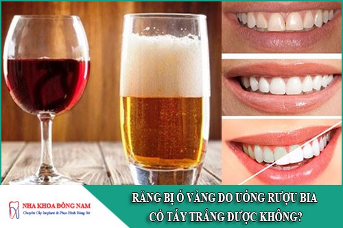răng bị ố vàng do rượu bia có tẩy trắng được không