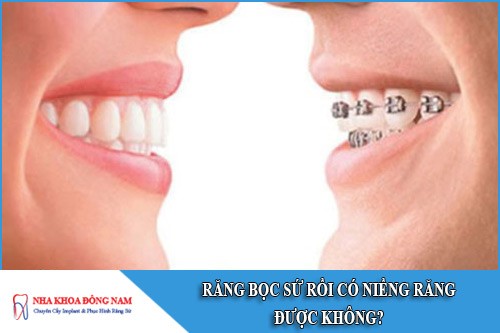 răng bọc sứ rồi có niềng răng được không