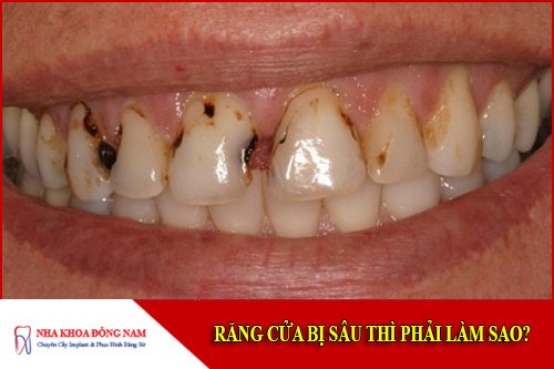 răng cửa bị sâu thì phải làm sao