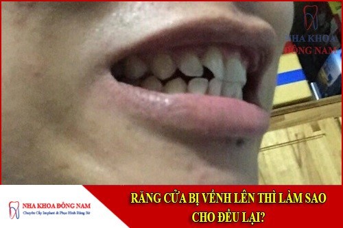 răng bị vểnh lên thì làm sao cho đều lại