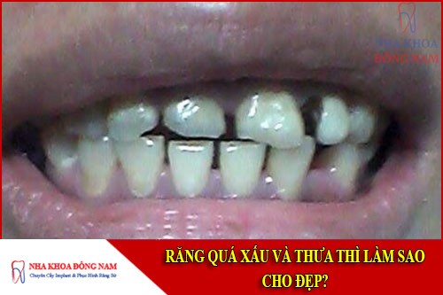 răng quá xấu và thưa thì phải làm sao cho đẹp