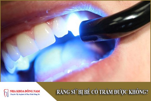 răng sứ bị bể có trám được không