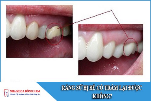 răng sứ bị bể có trám lại được không