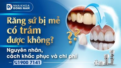 Răng sứ bị mẻ có trám được không? Nguyên nhân, cách khắc phục và chi phí
