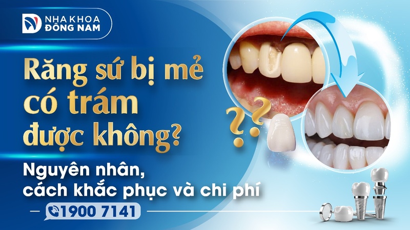 Răng sứ bị mẻ có trám được không? Nguyên nhân, cách khắc phục và chi phí
