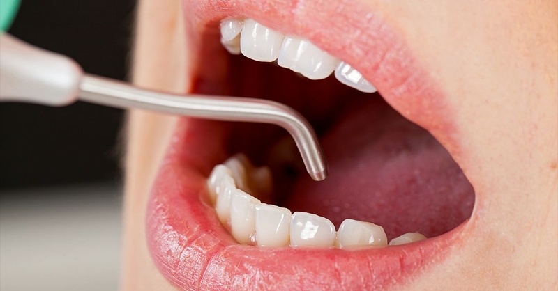 Răng sứ bị mẻ không thể trám lại hay tác động trực tiếp để phục hồi