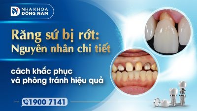 Răng sứ bị rớt: Nguyên nhân chi tiết, cách khắc phục và phòng tránh hiệu quả