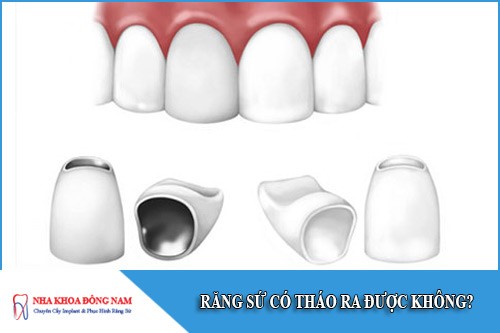 răng sứ có tháo ra được không
