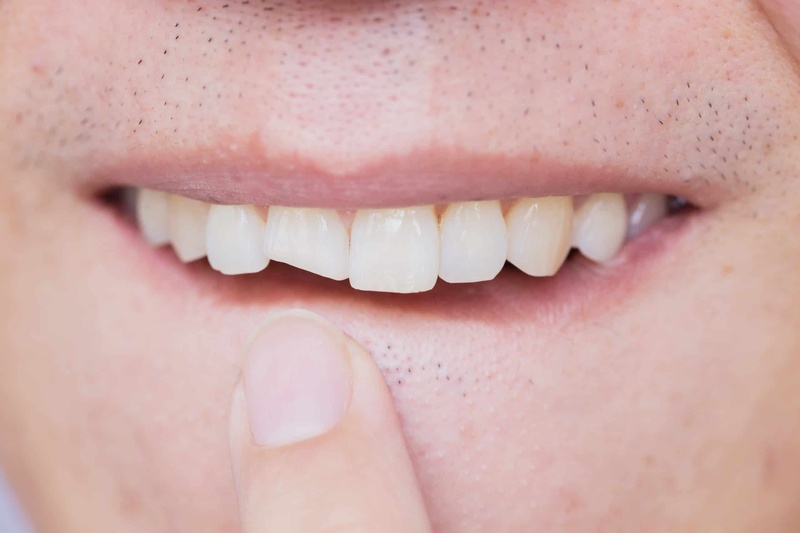Răng sứ mẻ có thể gây mất thẩm mỹ