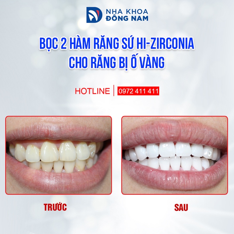 Răng sứ trắng trong đem lại nụ cười rạng rỡ, cuốn hút hơn