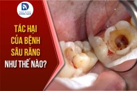 tác hại của bệnh sâu răng nguy hiểm như thế nào