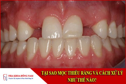 tại sao mọc thiếu răng và cách xử lý như thế nào