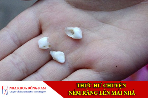 Thay răng sữa
