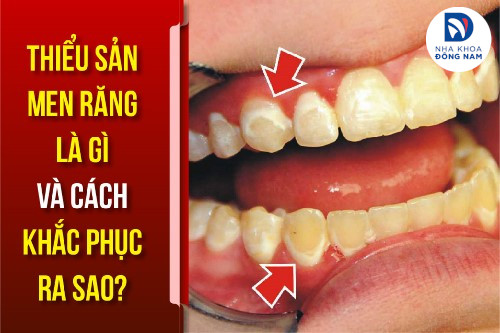 thiếu sản men răng là gì và cách khắc phục ra sao
