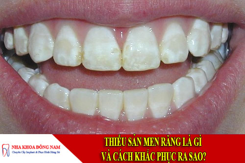 thiểu sản men răng là gì và cách khắc phục ra sao