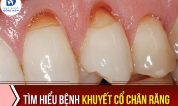 tìm hiểu bệnh khuyết cổ chân răng