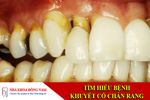 tim hieu benh khuyet co chan rang