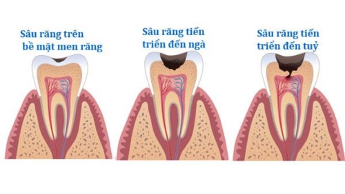 quá trình sâu răng