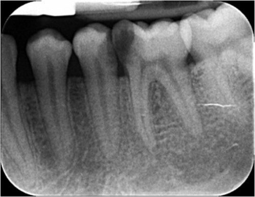chụp phim x-quang răng