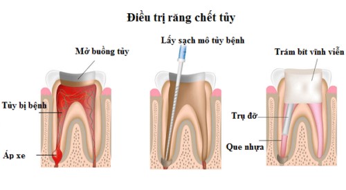 mô phỏng quy trình lấy tủy răng