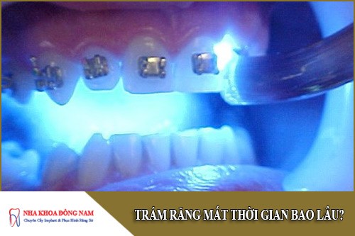 trám răng mất thời gian bao lâu