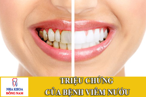 trieu chung cua benh viem nuou