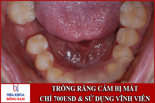 trồng răng cấm bị mất chỉ với 700usd -1